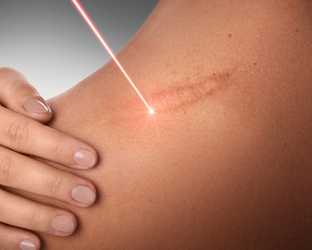 Trị Sẹo Rỗ Sẹo Lõm Bằng Laser Tại Sen Beauty